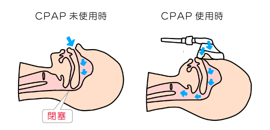 CPAP未使用時とCPAP使用時の比較イラスト